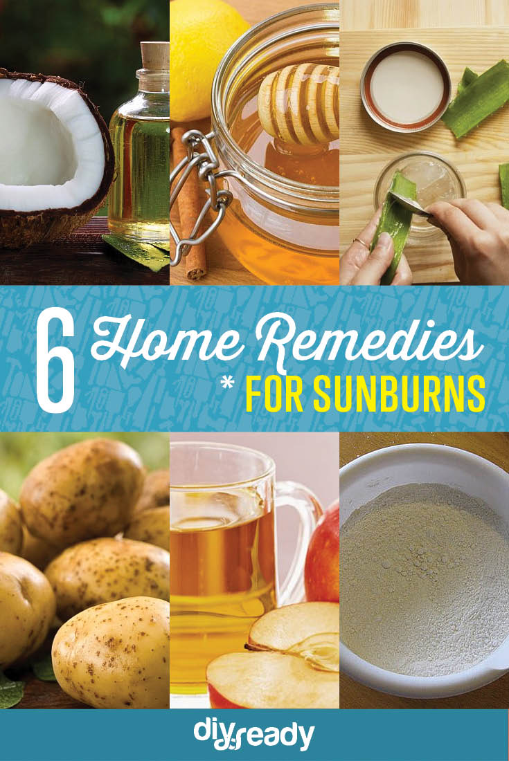 6 Home Remedies For Sunburn DIY Ready